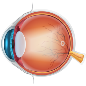 Diagram of lens affected by cataracts